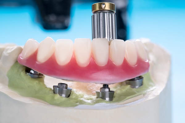 Benefits Of Implant Supported Dentures