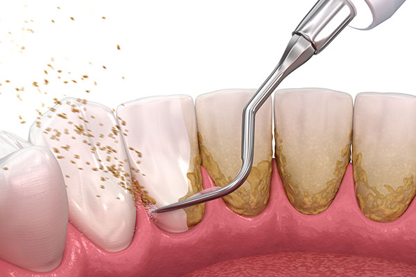 Oral Hygiene Basics: What Are Tartar And Plaque?